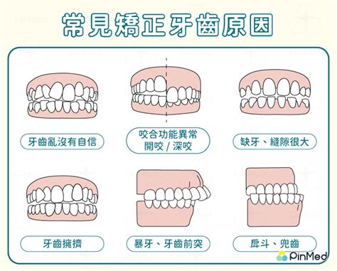 臉型會改變嗎|牙齒矯正｜戴牙套之後臉型會改變嗎